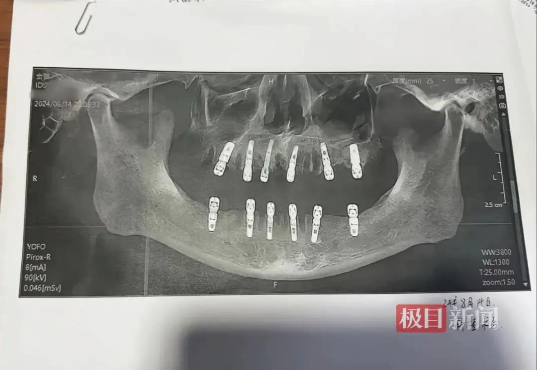 拔牙前要告诉医生这些事！