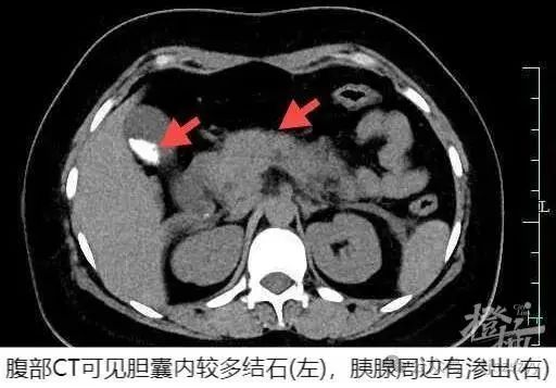 一口气干掉4只，女子连夜抢救！餐桌上有这道菜的注意了